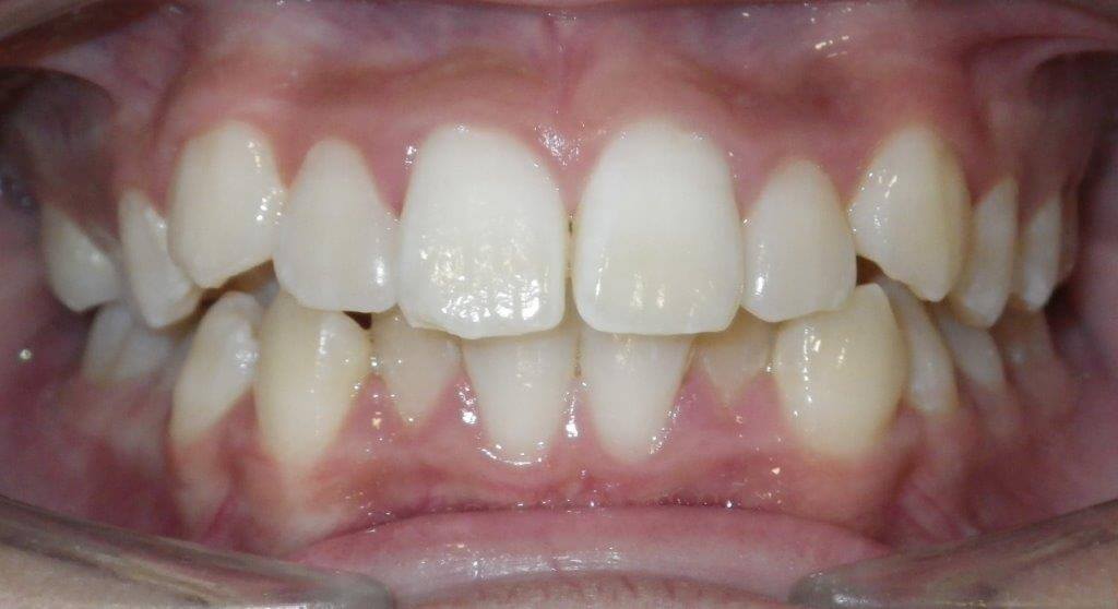, Before &#038; After, Smileworx Orthodontics