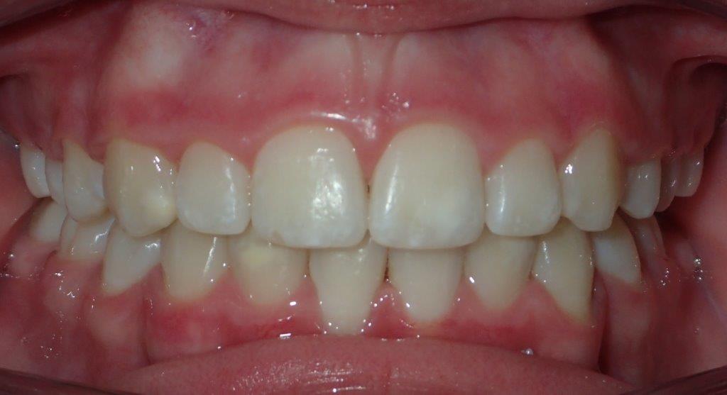 , Before &#038; After, Smileworx Orthodontics
